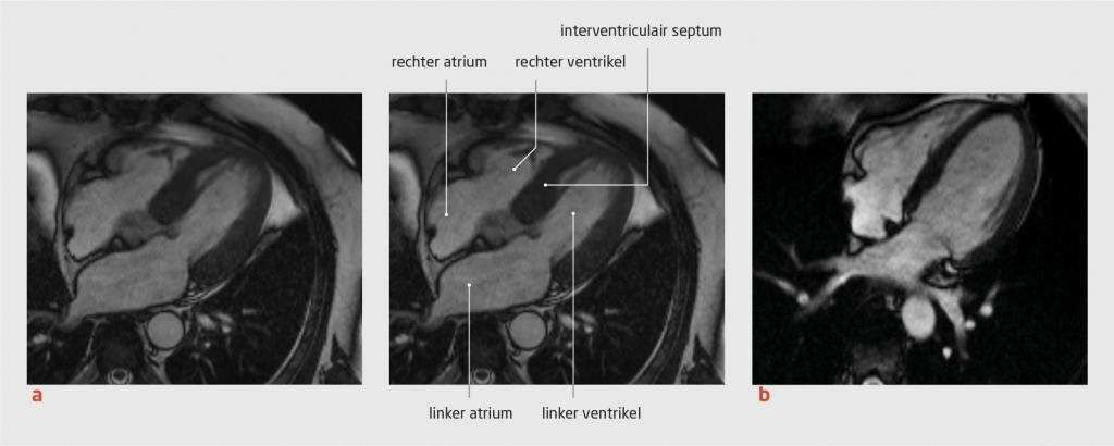 Figuur 1 | Hypertrofische cardiomyopathie in beeld