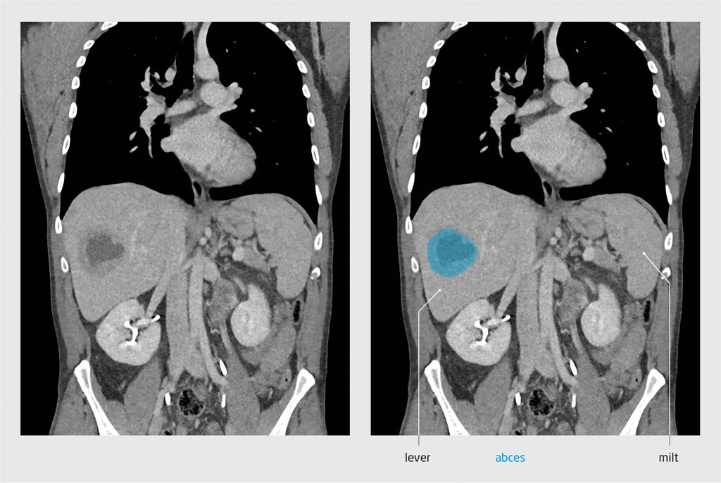Figuur 1 | Leverabces bij patiënt A