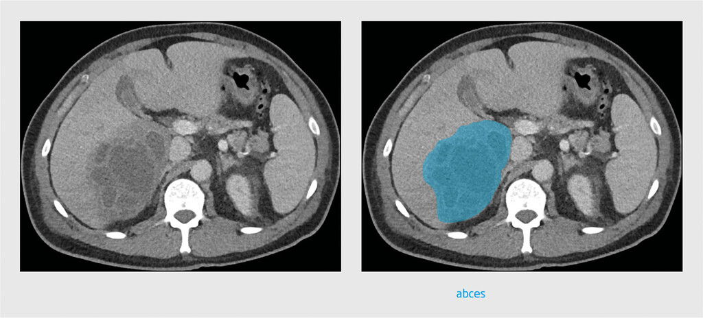 Figuur 2 | Leverabces bij patiënt B