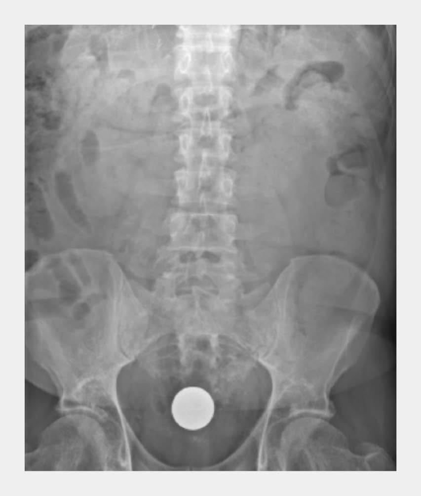 Figuur 1 | IJzeren bal in rectum van patiënt A | Anterieur-posterieure buikoverzichtsfoto