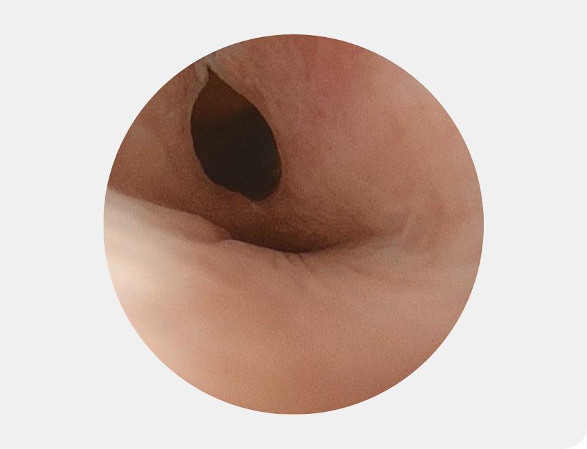 Figuur 1 | Urethrale fistel door erosieve schade
