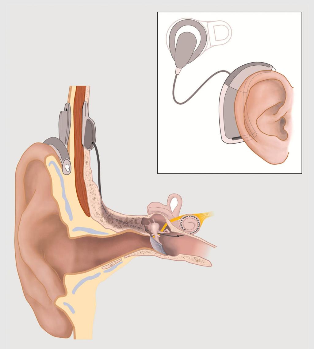 Figuur 1 | Waaruit bestaat een cochleair implantaat?