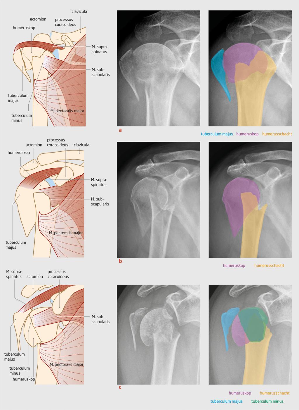 Figuur 1 | Voorbeelden van proximale humerusfracturen