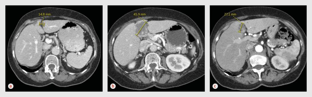 Figuur 3 | Pseudoprogressie bij patiënt C