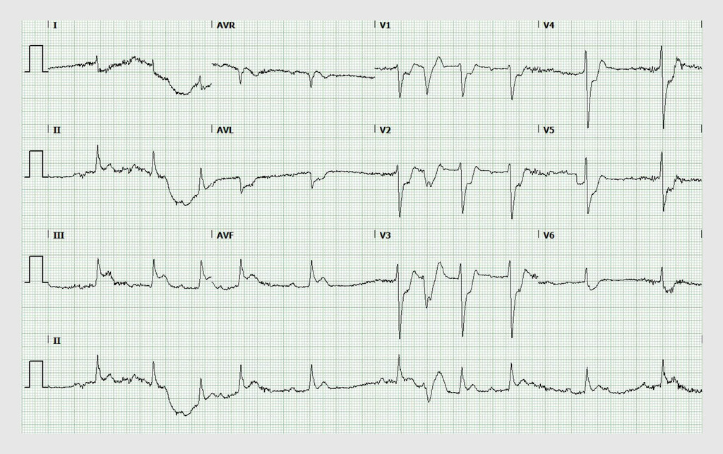 Figuur 1 | Ecg van een patiënt die plotseling hypotensief was geworden na toediening van diclofenac