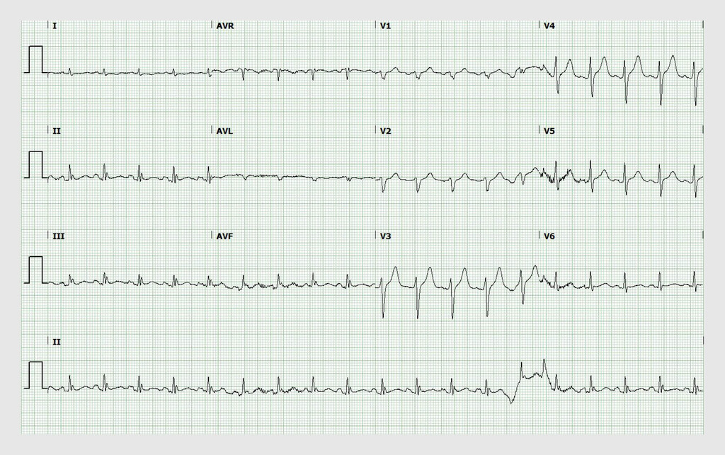 Figuur 2 | Ecg na herstel van de bloeddruk bij de patiënt