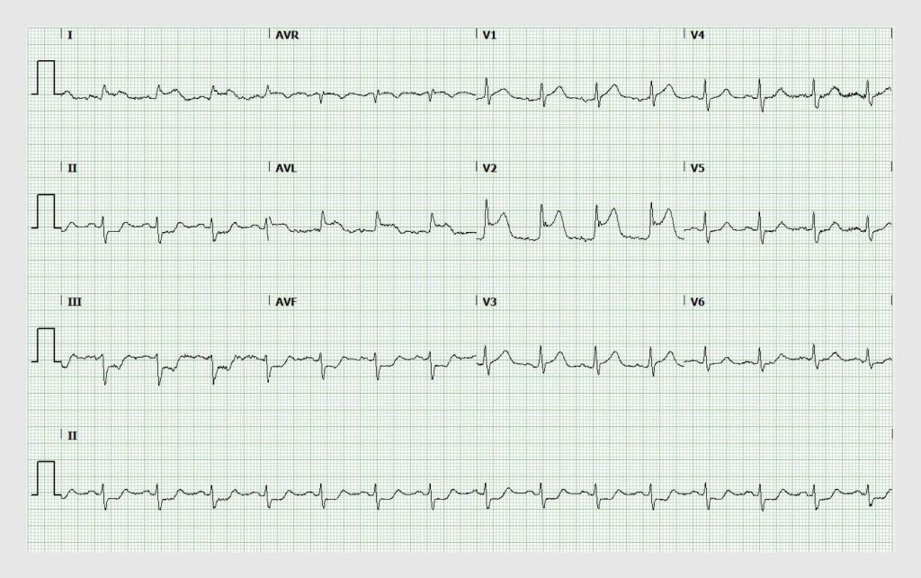 Figuur 3 | Ecg ten tijde van pijn op de borst