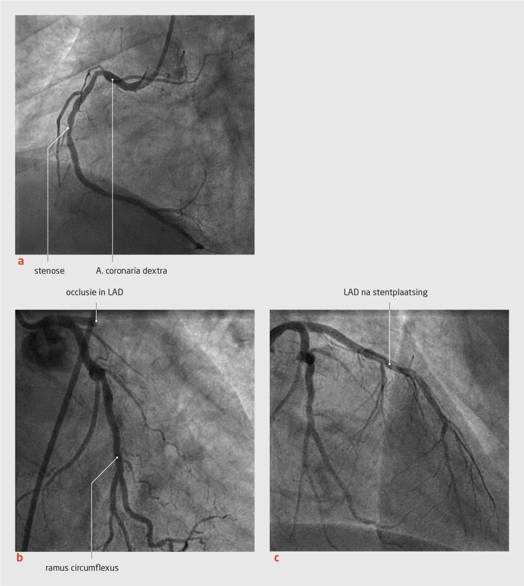 Figuur 4 | Acuut voorwandinfarct bij een anafylactische reactie | Coronairangiogrammen van een patiënt met het Kounis-syndroom