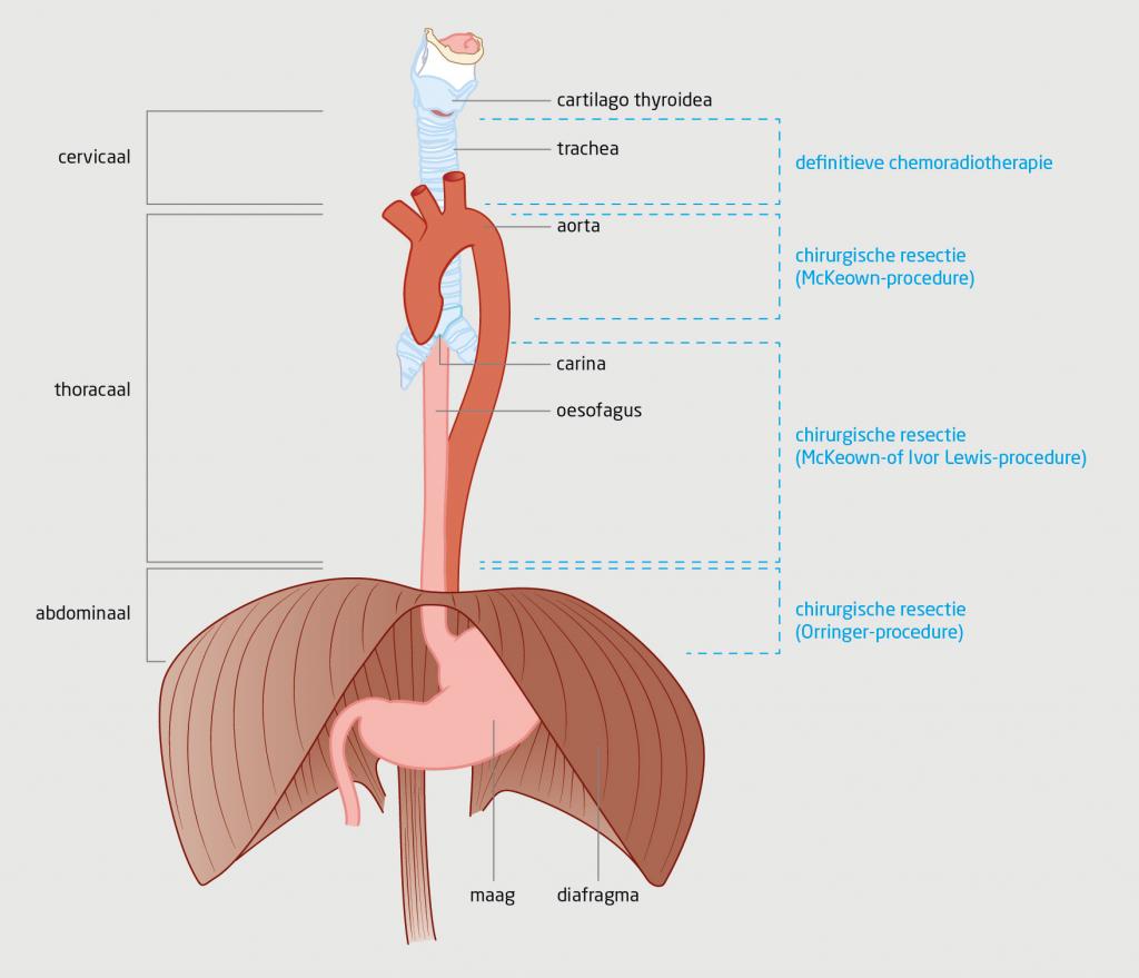 Figuur 2 | Anatomie van de slokdarm en behandelingen van slokdarmkanker