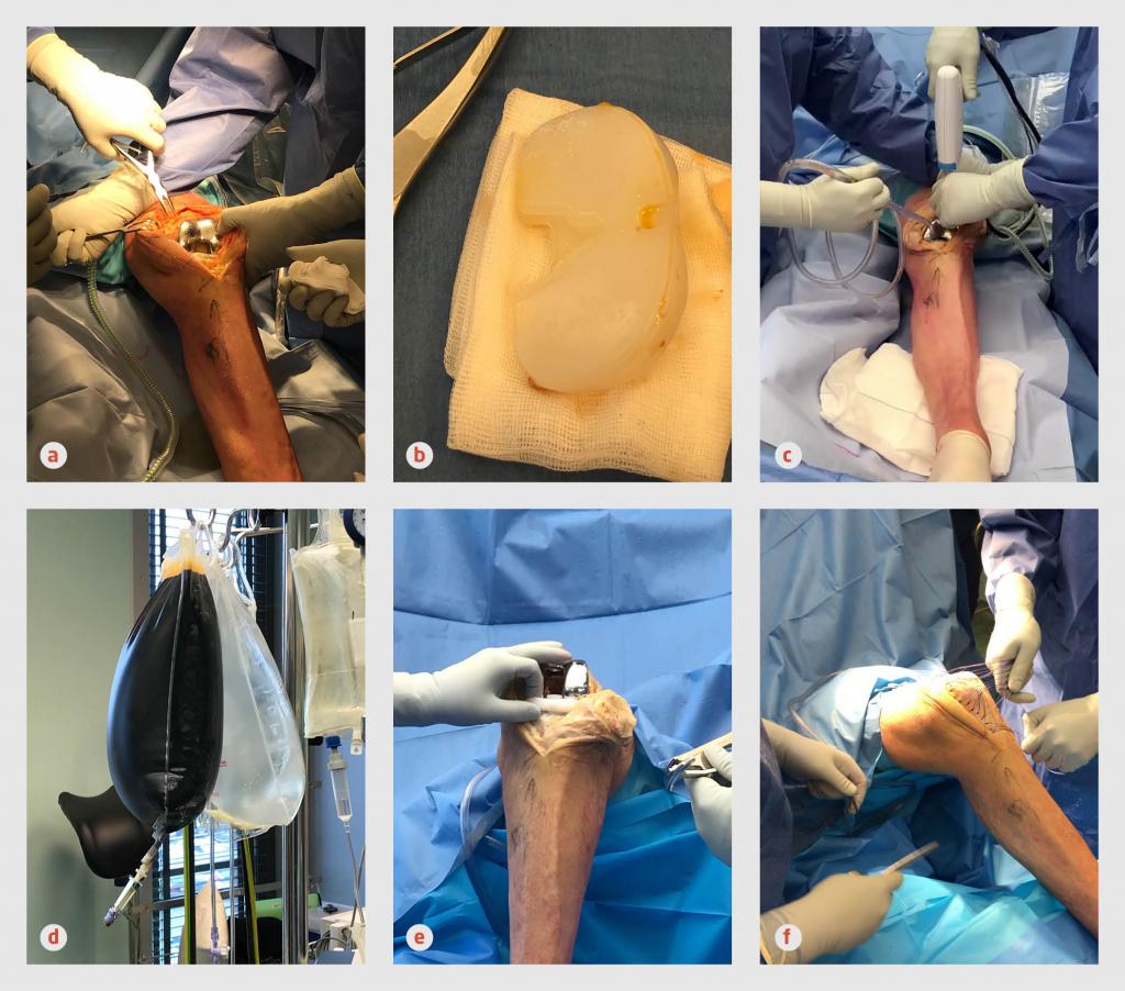 Figuur 2 | Chirurgisch débridement van een geïnfecteerde knieprothese