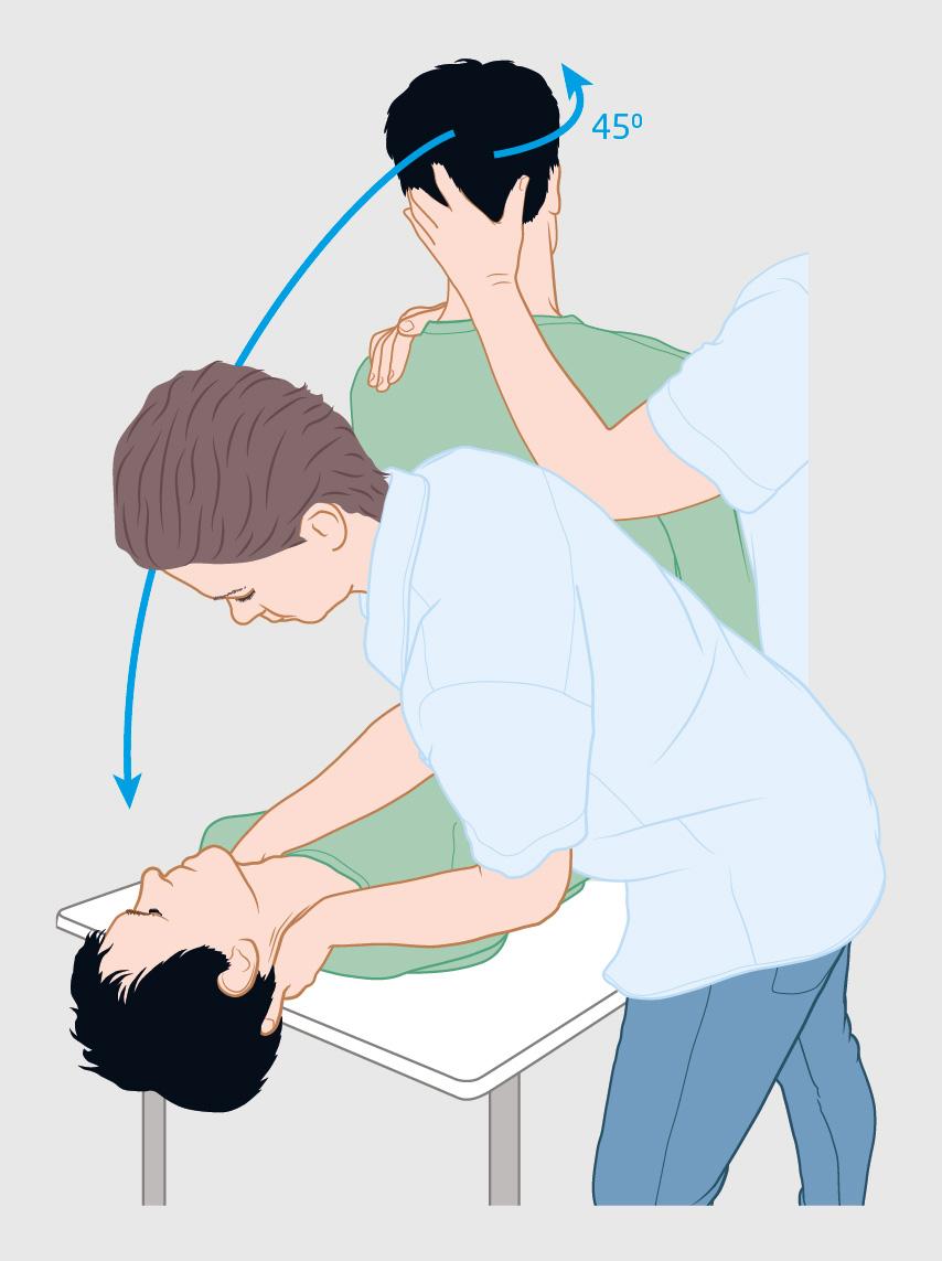 Figuur 1 | Provocatieproef van Dix-Hallpike