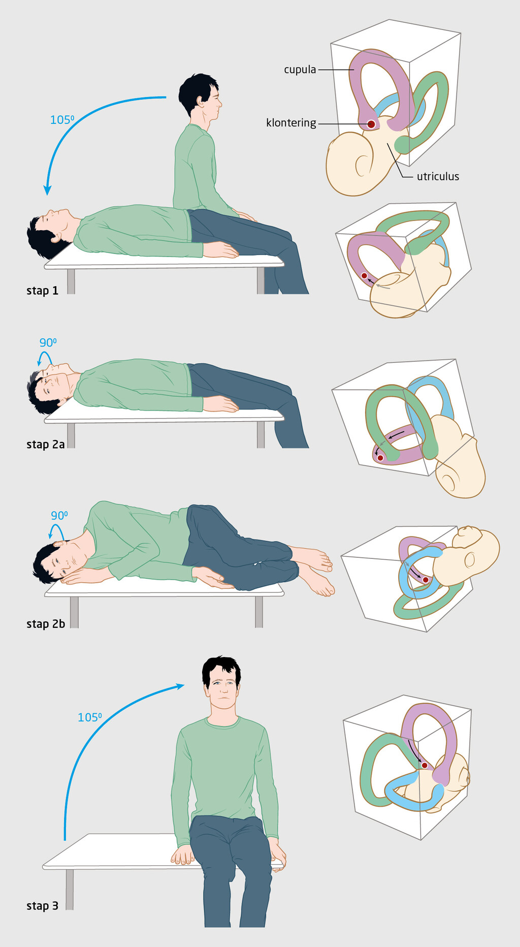 Figuur 2 | Therapeutische kantelmanoeuvre volgens Epley
