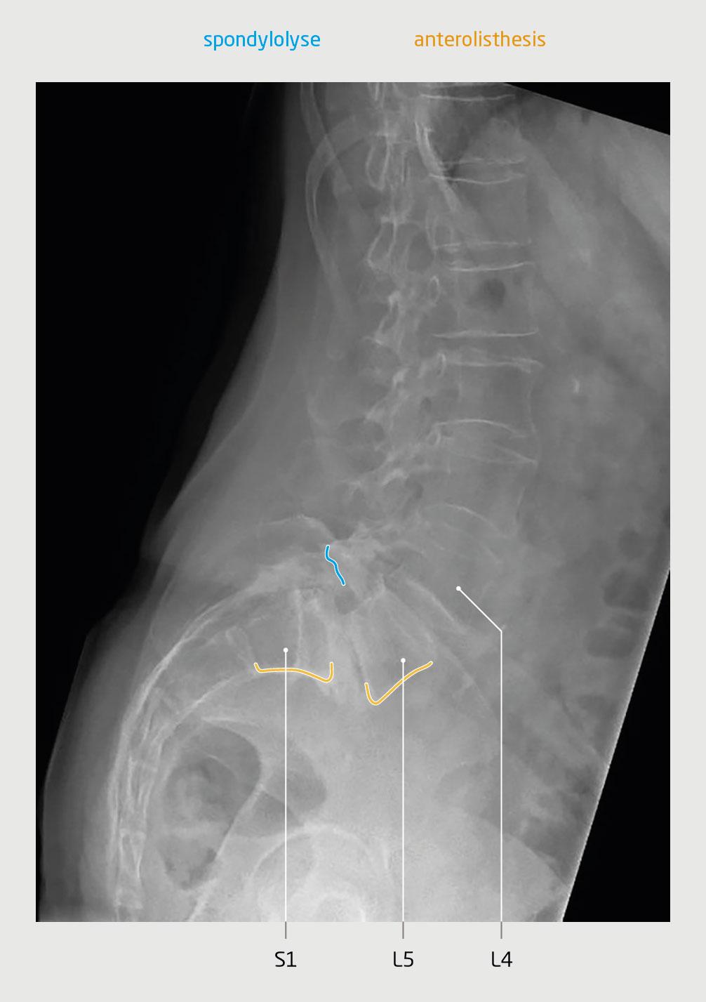 Figuur 1 | Lytische spondylolisthesis