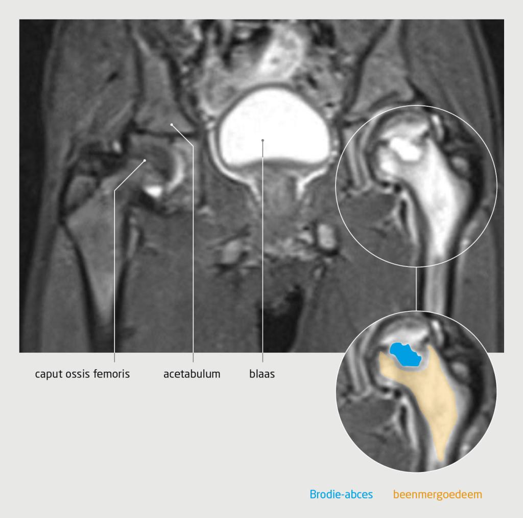 Figuur 1 | Subacute osteomyelitis bij een jongen van 8 jaar door een infectie met Kingella kingae