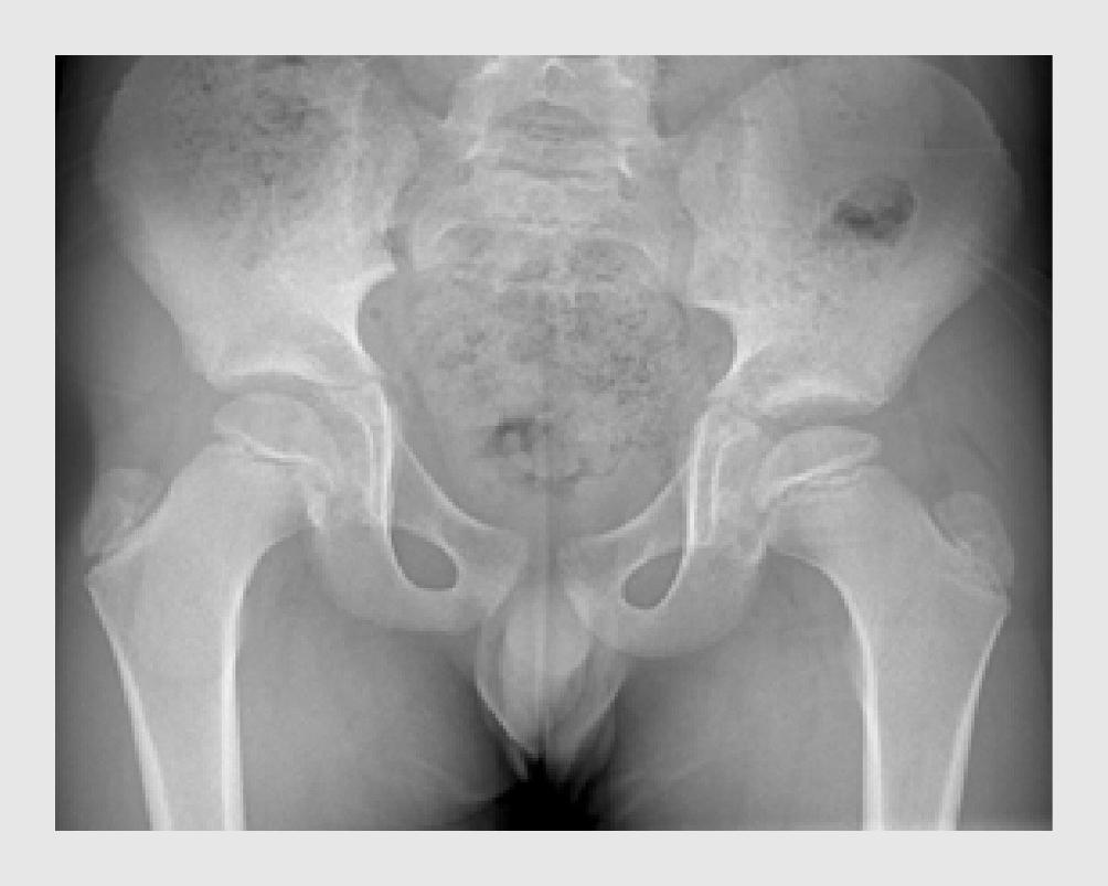 Figuur 2 | De ziekte van Perthes bij een 8-jarige jongen