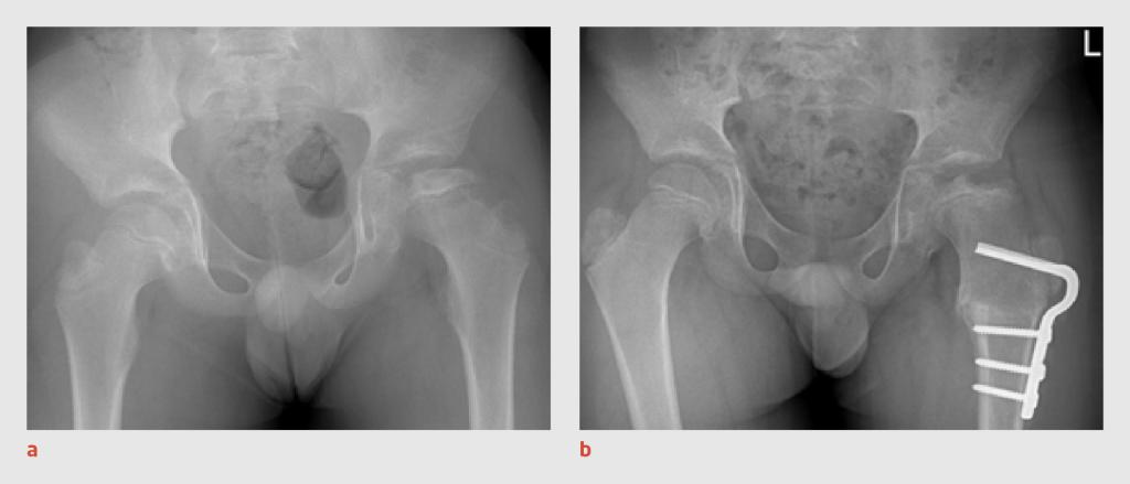 Figuur 3 | Progressie en behandeling van de ziekte van Perthes