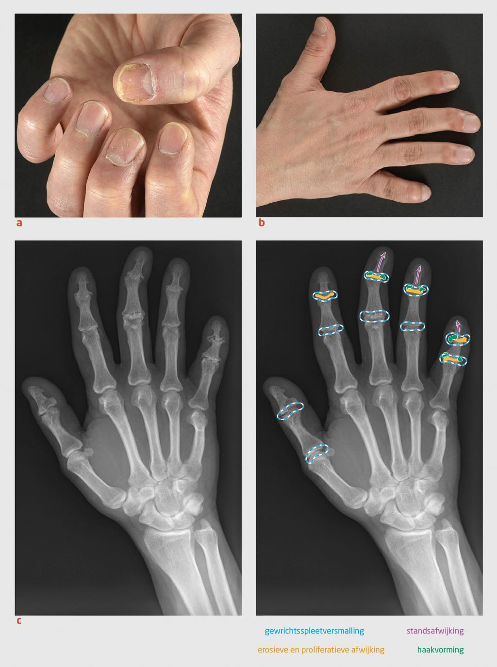 Figuur 2 | Klinische manifestaties psoriasis en artritis psoriatica