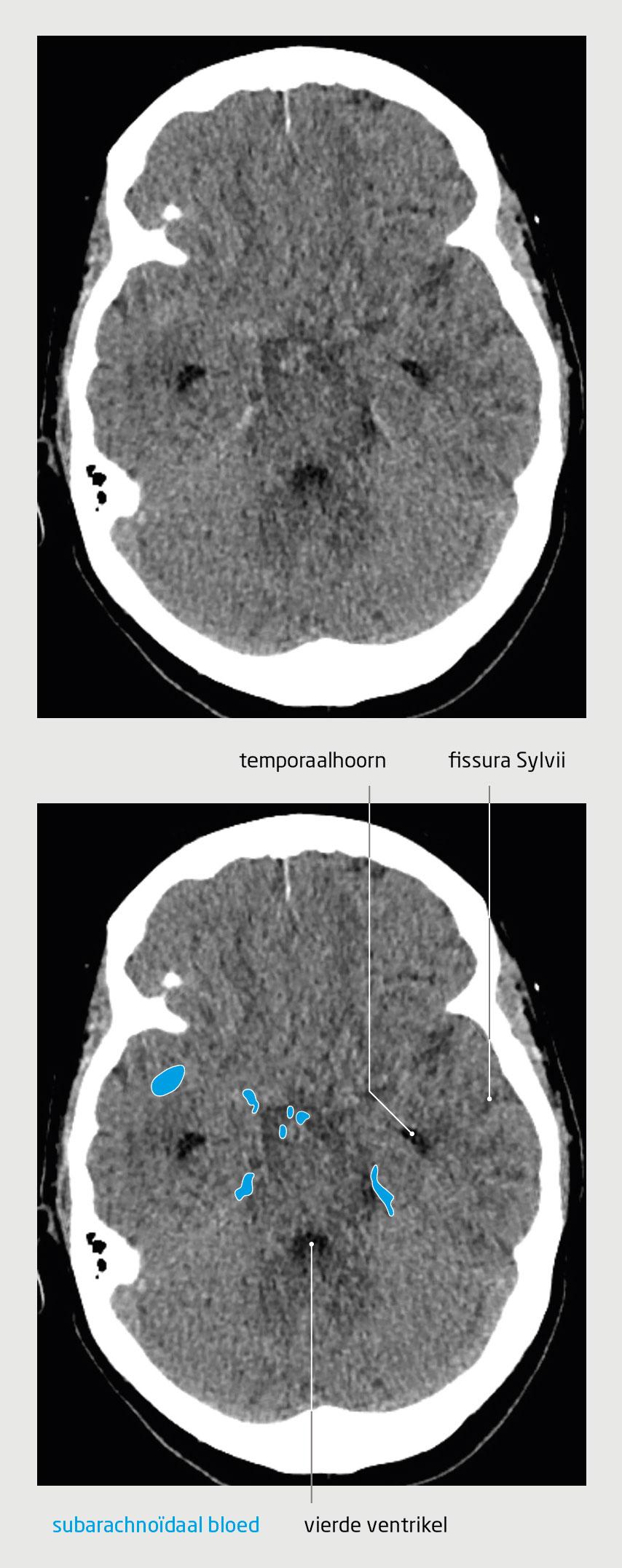 Figuur 1 | Subarachnoïdale bloeding | CT-scan van de hersenen van patiënt A
