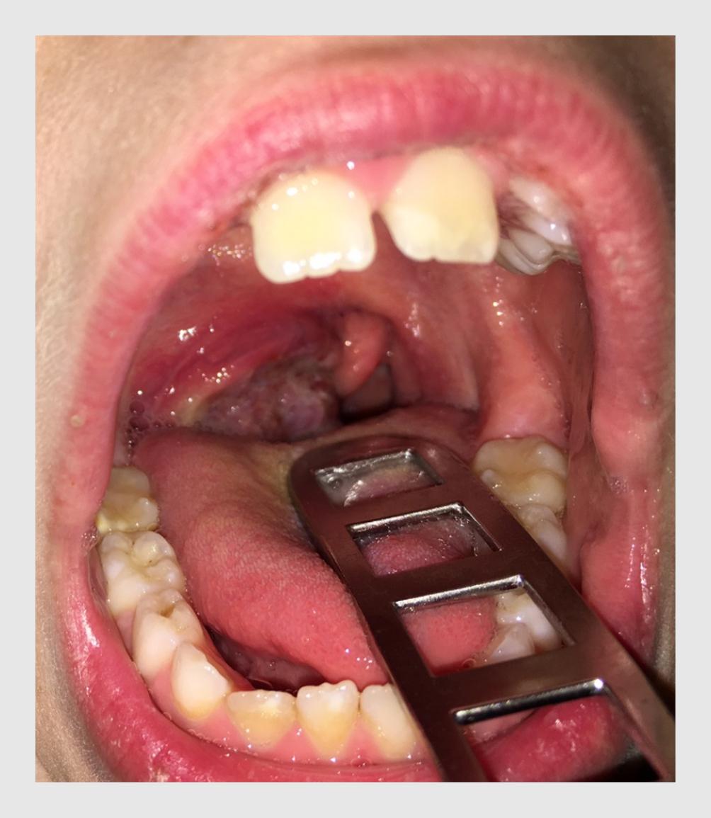 Figuur 1 | Eenzijdig vergrote tonsil van patiënt A