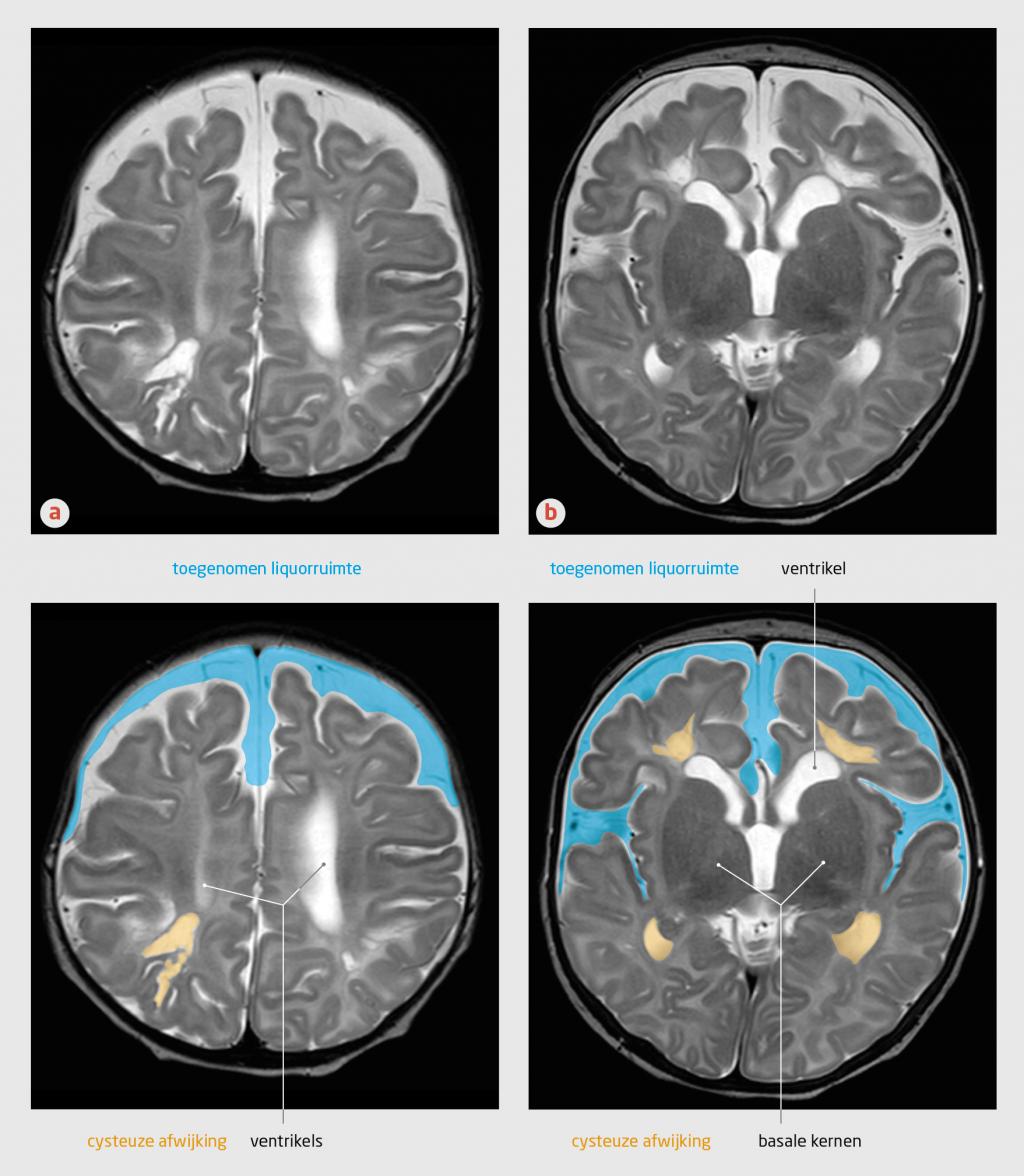 Figuur 2 | Restafwijkingen in de hersenen van een zuigeling na encefalitis door rotavirus
