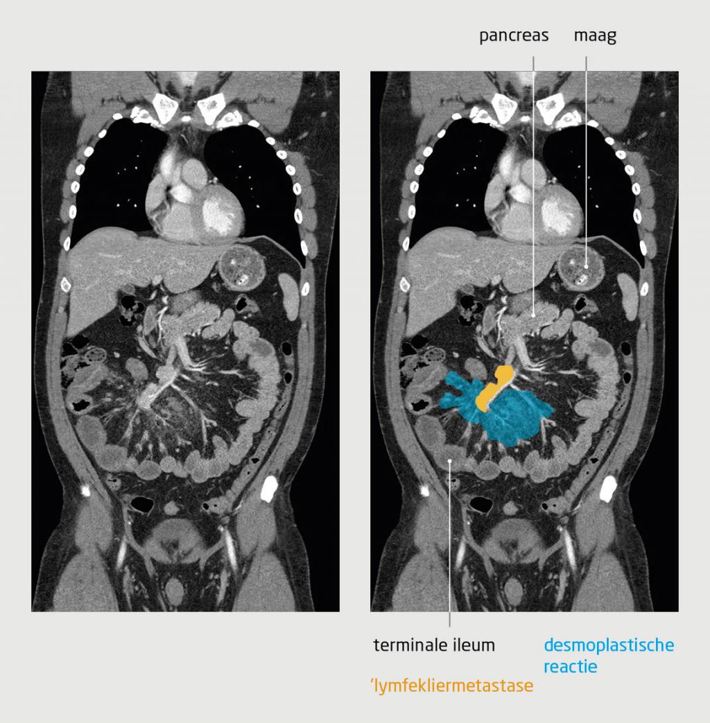 Figuur 1 | CT-scan van het abdomen van patiënt A, | een patiënt met buikpijn, diarree en aanvallen van roodheid en transpireren