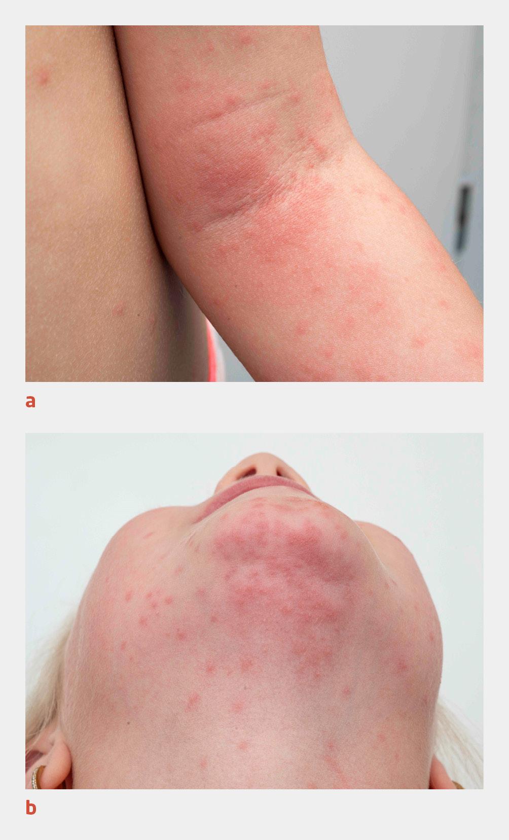 Figuur 1 | Huiduitslag door de eikenprocessierups