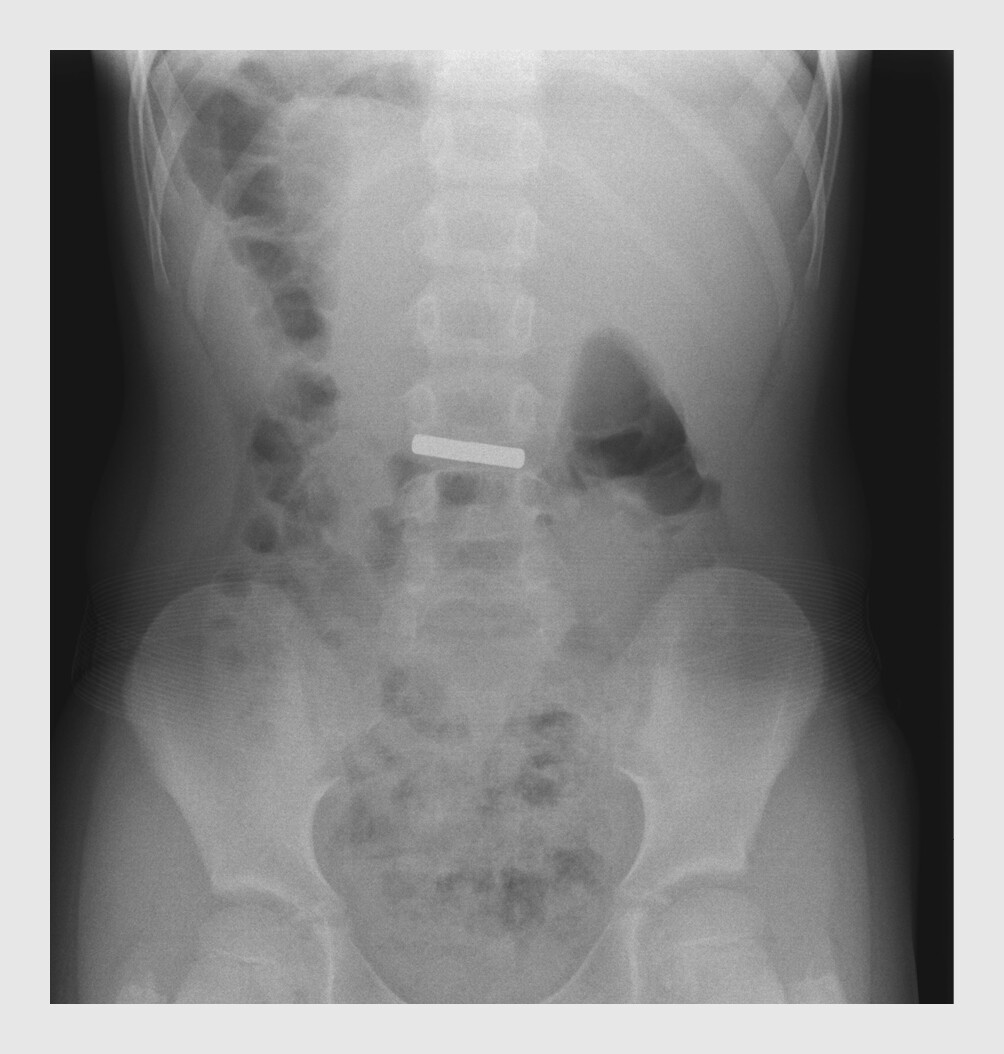 Figuur 1 | Ingeslikte koelkastmagneten