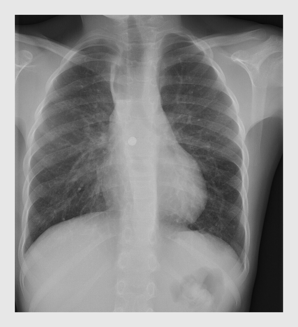 Figuur 2 | Ingeslikte knoopcelbatterij