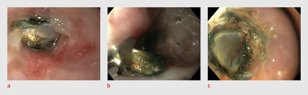 Figuur 3 | Ingeslikte knoopcelbatterij