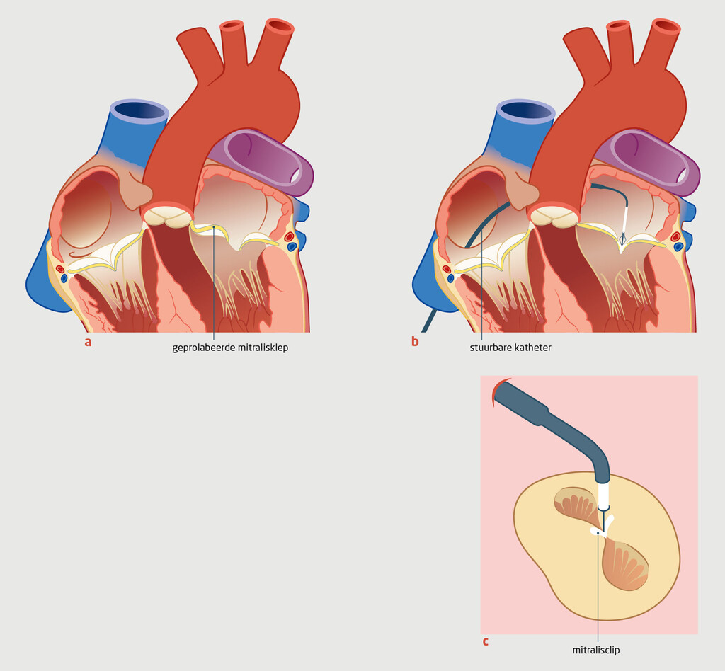 Figuur 3 | Plaatsing van een mitralisclip