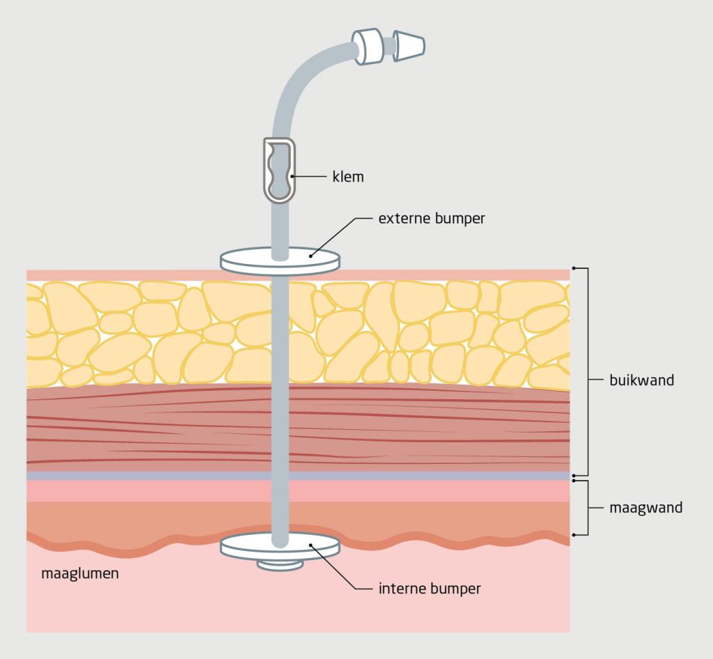 Figuur 1 | Het principe van de percutane endoscopische gastrostomie(PEG)-sonde