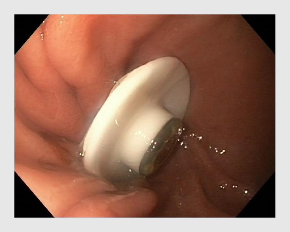 Figuur 2 | PEG-sonde met intern fixatieplaatje (‘bumper’)