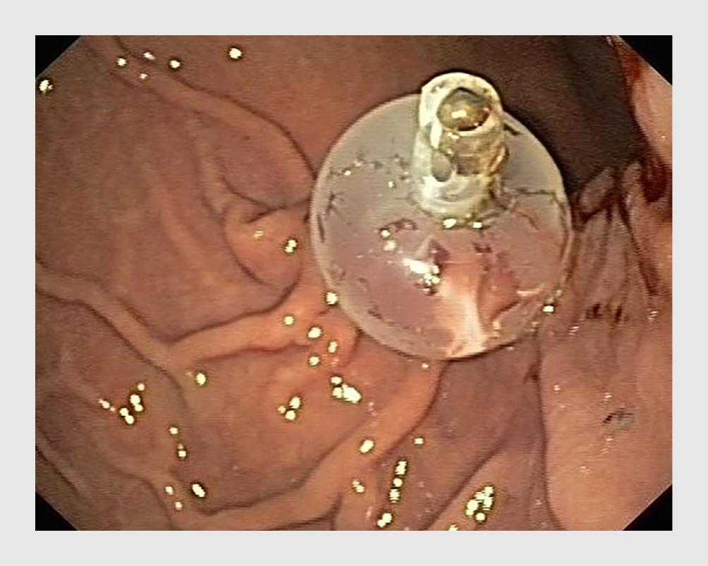 Figuur 3 | PEG-sonde met ballonfixatie