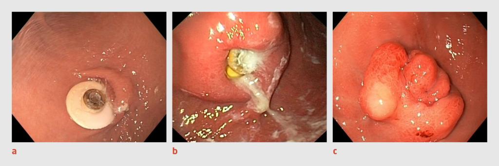 Figuur 4 | Stadia in het ontstaan van het ‘buried bumper’-syndroom | Bij dit syndroom raakt het interne fixatieplaatje van een PEG-sonde overgroeid door maagslijmvlies