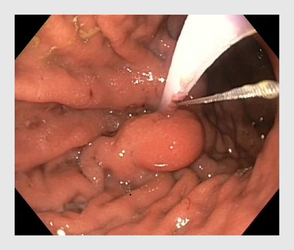 Figuur 5 | Flamingo-instrument, ontworpen om ‘buried bumpers’ te verwijderen