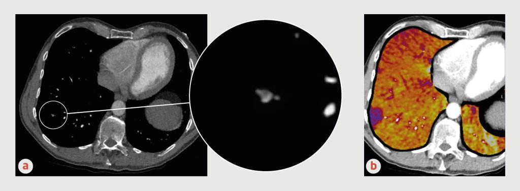 Figuur 1 | Geïsoleerde subsegmentele longembolie