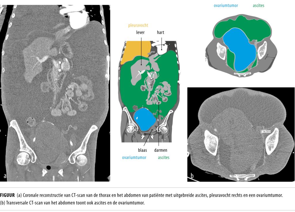 Ascites Pleuravocht En Een Benigne Ovariumtumor NTvG