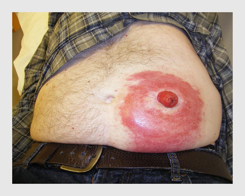 Figuur | Irritatieve contactdermatitis bij de patiënt met een stoma