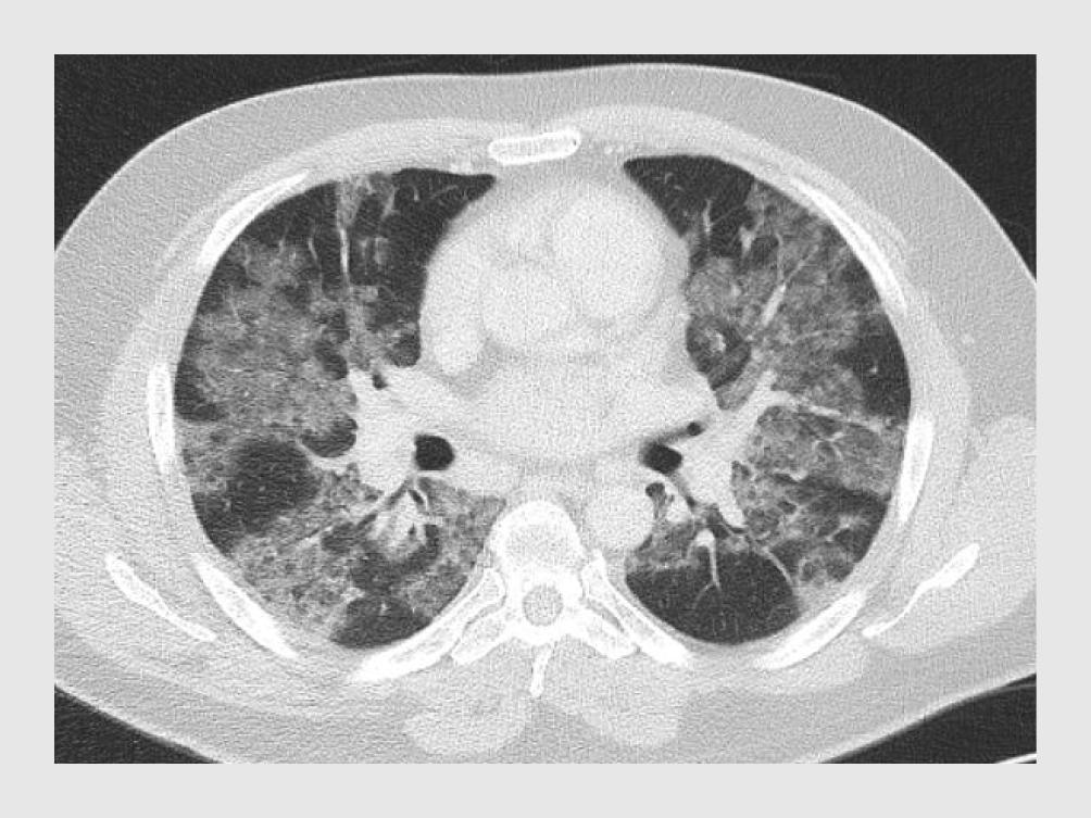 Figuur 2 | CT-scan van een patiënt met COVID-19