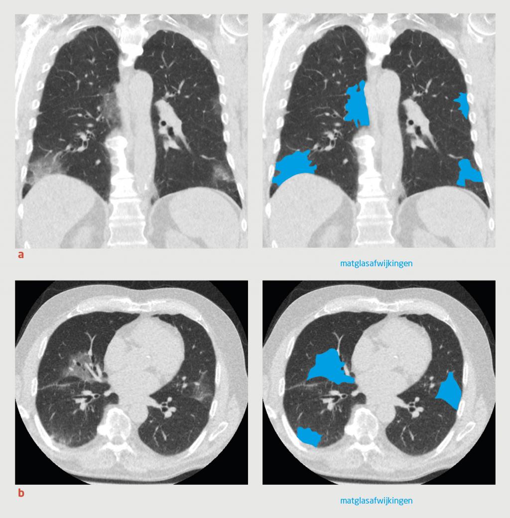 Figuur | CT-scan van een patiënt met COVID-19