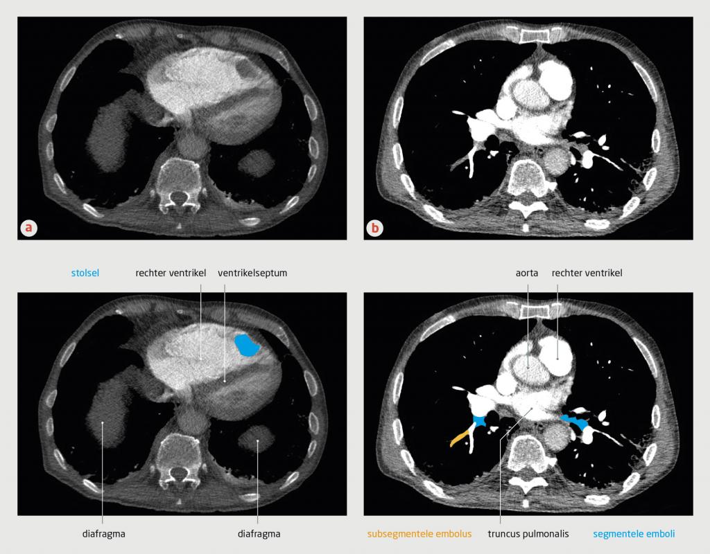 Figuur 3 | CT-angiografie van de thorax van patiënt C