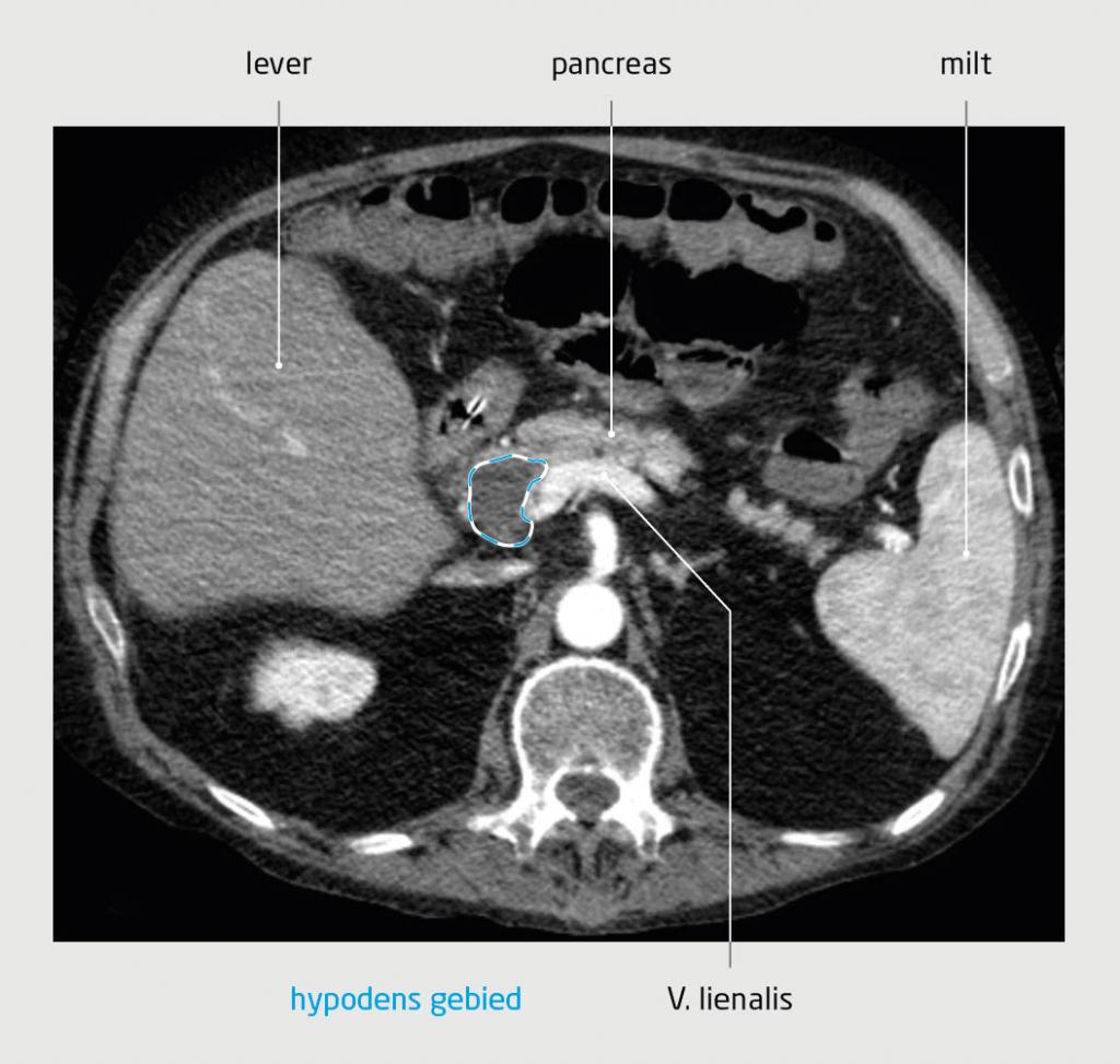 Figuur 4 | Hypodense afwijking in de pancreaskop