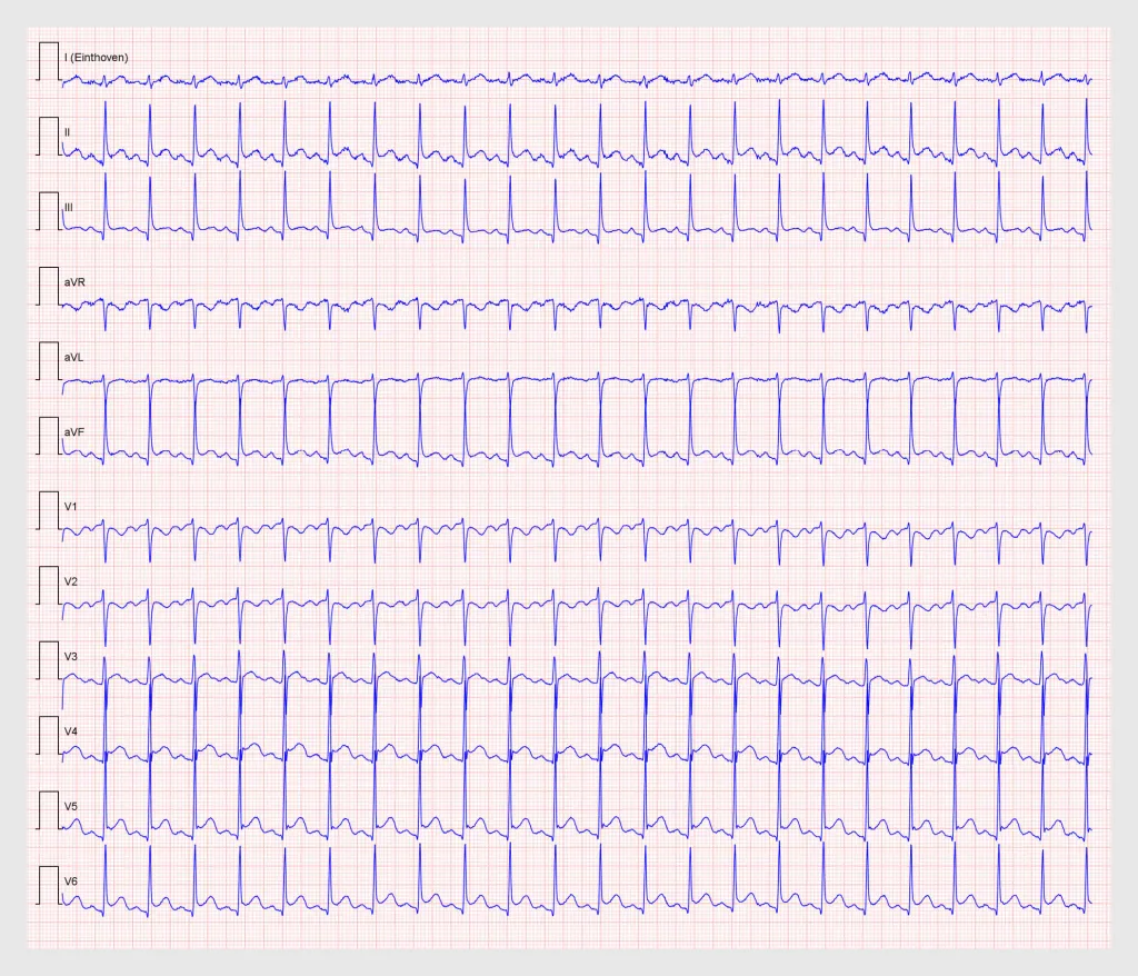 Figuur 1 | Ecg van de patiënte bij binnenkomst op de Spoedeisende Hulp