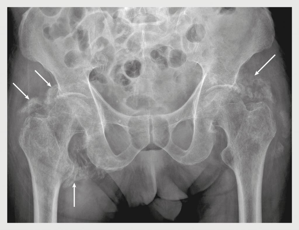 Figuur 3 | Heterotope ossificaties rondom de coxofemorale gewrichten van patiënt B.