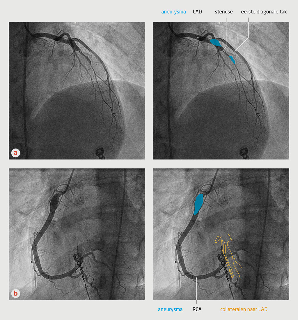Figuur 1 | Linker en rechter coronairarterie van een 18-jarige man met een acuut myocardinfarct