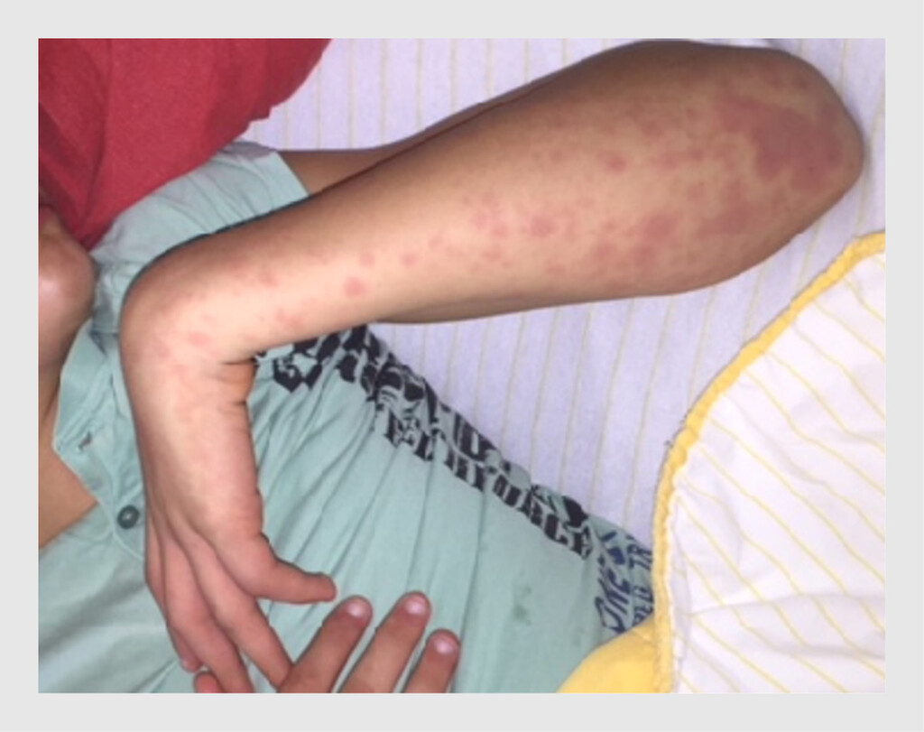 Figuur 2 | Exantheem op de onderarm van de patiënt