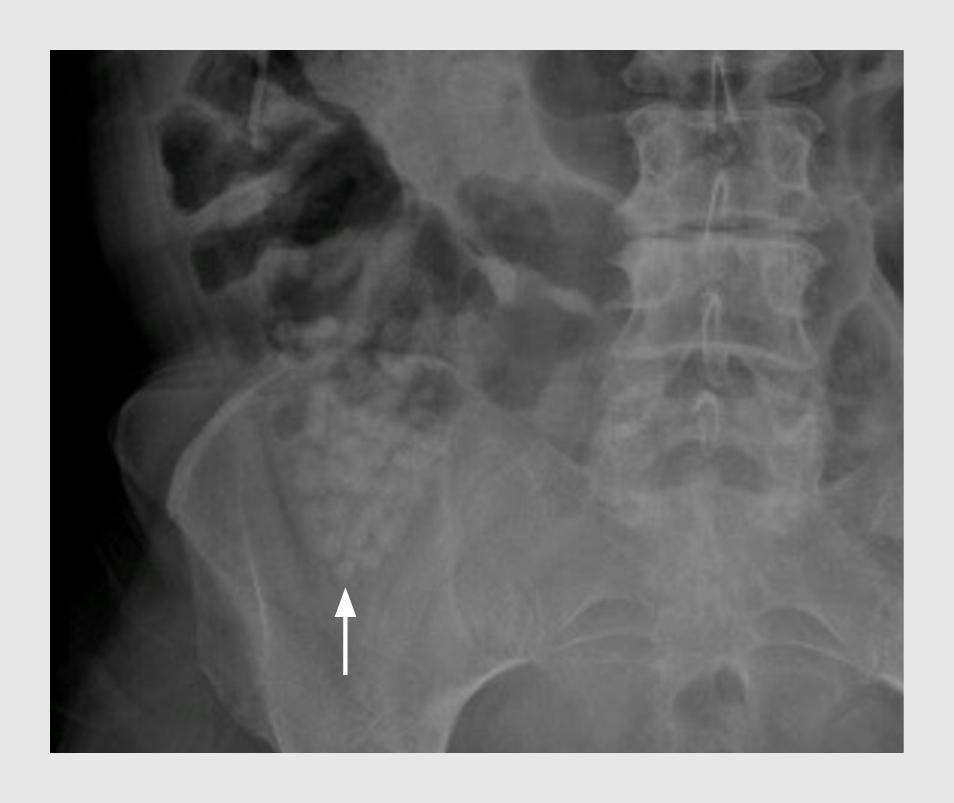 Figuur | Bezoar in het caecum