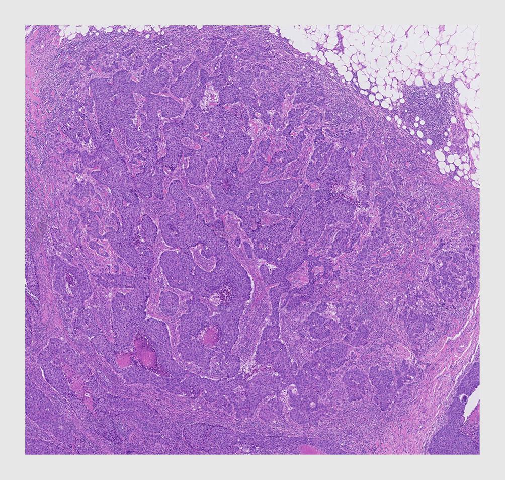 Figuur | Gradering van het invasief mammacarcinoom varieert aanzienlijk tussen pathologielaboratoria