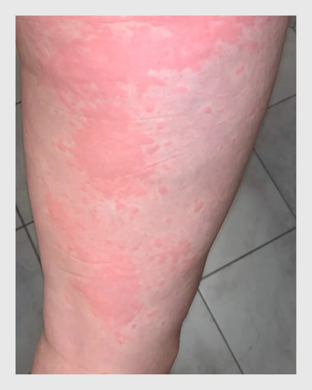 Figuur 4 | Acute urticaria