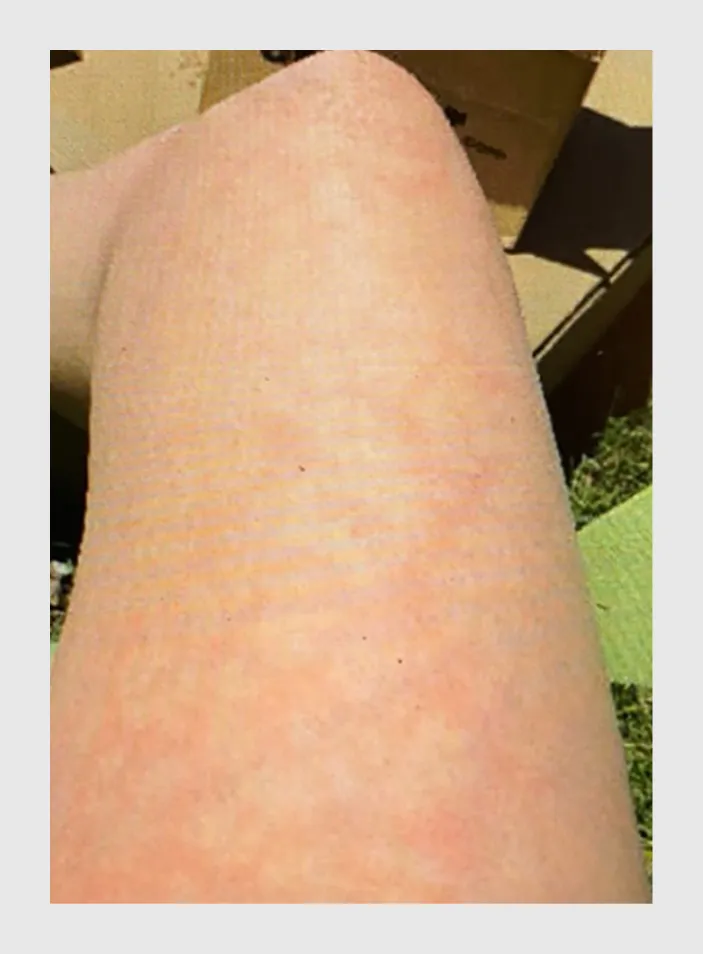 Figuur 5 | Livedo reticularis